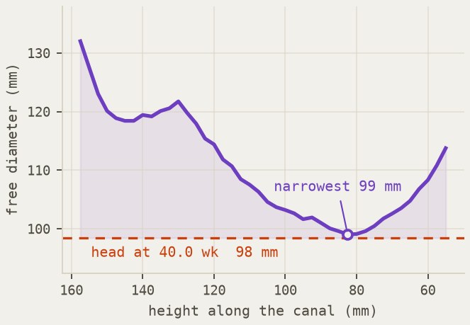 Free diameter along the canal, narrowest 99 mm, against a 98 mm head at 40 weeks.